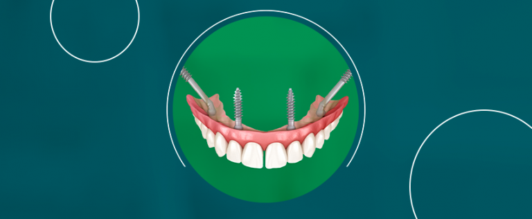 implantes zigomáticos